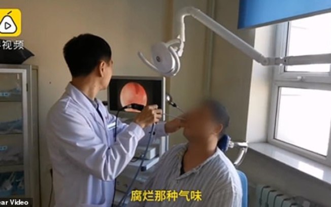 Dente cresce dentro de nariz de um homem